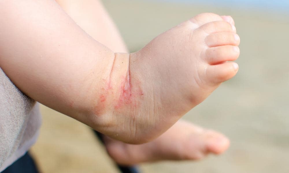 Kids Vitamins for Eczema: Here's how VItamin D3 can help.Discover how Vitamin D can help support your child's eczema symptoms.